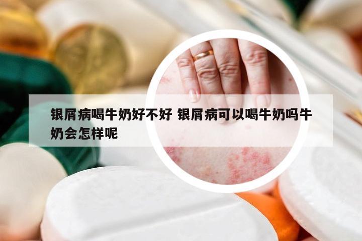 银屑病喝牛奶好不好 银屑病可以喝牛奶吗牛奶会怎样呢