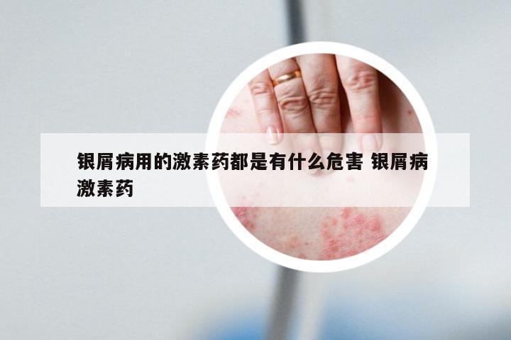 银屑病用的激素药都是有什么危害 银屑病 激素药