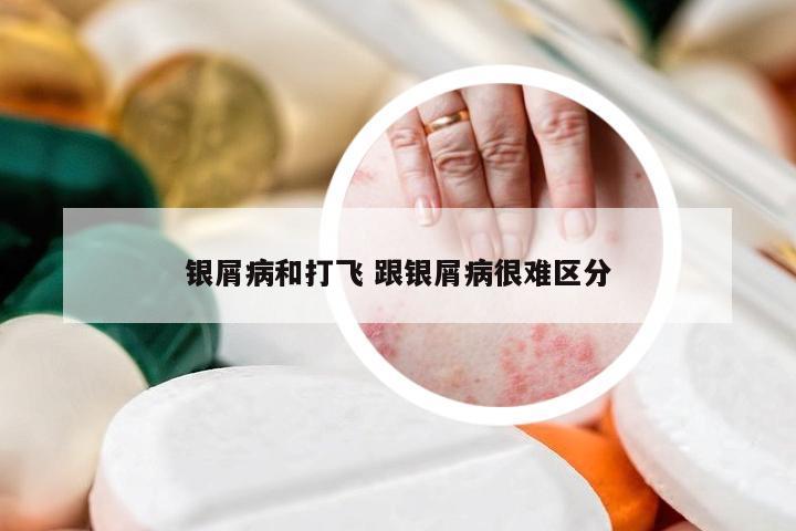 银屑病和打飞 跟银屑病很难区分