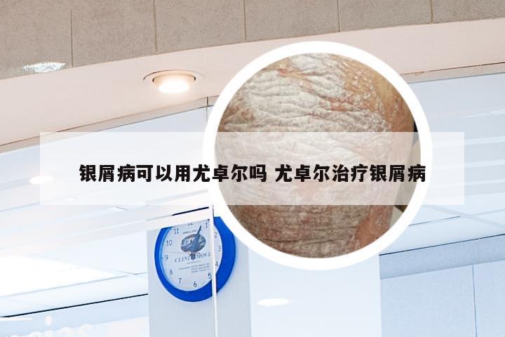银屑病可以用尤卓尔吗 尤卓尔治疗银屑病