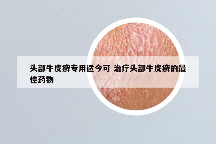 头部牛皮癣专用适今可 治疗头部牛皮癣的最佳药物