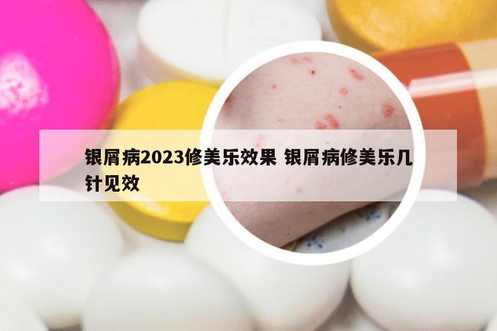 银屑病2023修美乐效果 银屑病修美乐几针见效