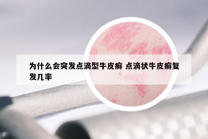 为什么会突发点滴型牛皮癣 点滴状牛皮癣复发几率