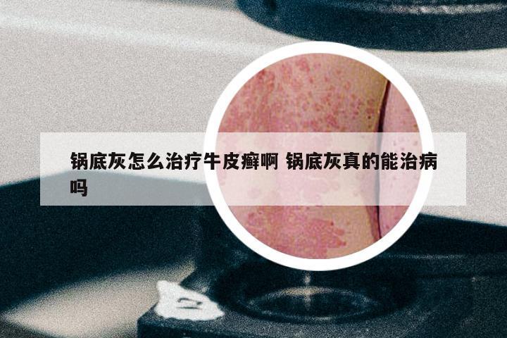 锅底灰怎么治疗牛皮癣啊 锅底灰真的能治病吗