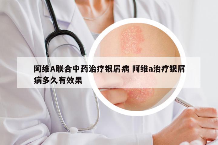 阿维A联合中药治疗银屑病 阿维a治疗银屑病多久有效果