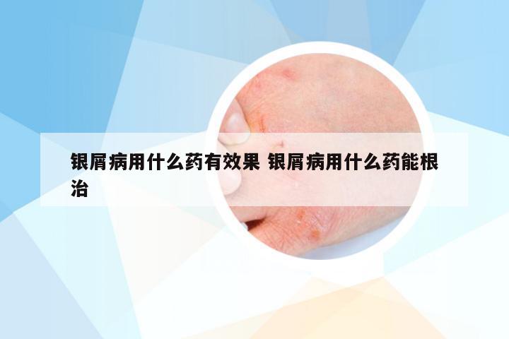 银屑病用什么药有效果 银屑病用什么药能根治