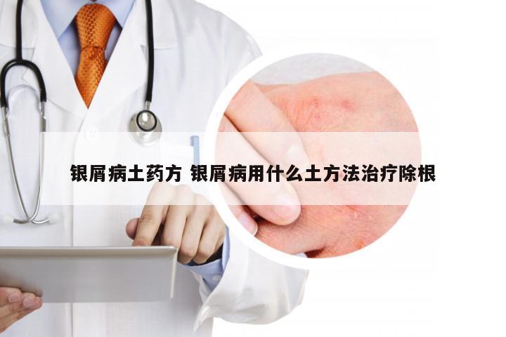 银屑病土药方 银屑病用什么土方法治疗除根