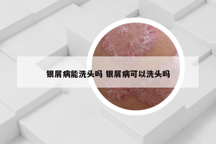 银屑病能洗头吗 银屑病可以洗头吗