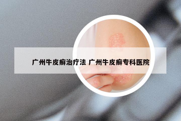 广州牛皮癣治疗法 广州牛皮癣专科医院