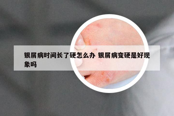 银屑病时间长了硬怎么办 银屑病变硬是好现象吗