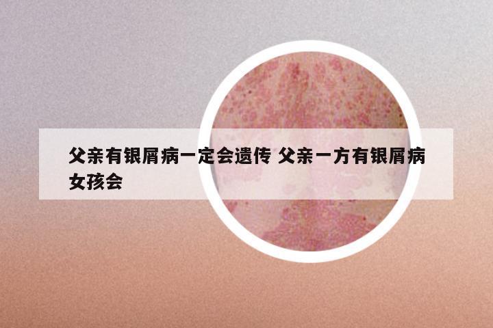 父亲有银屑病一定会遗传 父亲一方有银屑病女孩会