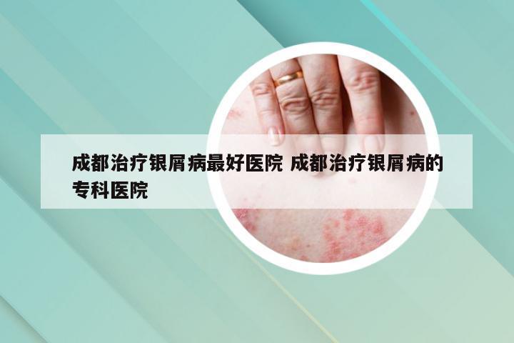 成都治疗银屑病最好医院 成都治疗银屑病的专科医院