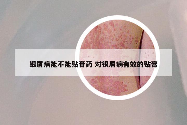 银屑病能不能贴膏药 对银屑病有效的贴膏