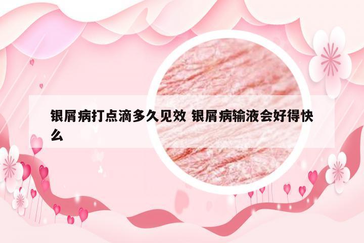 银屑病打点滴多久见效 银屑病输液会好得快么