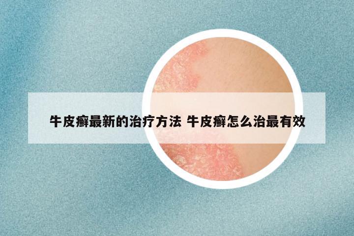 牛皮癣最新的治疗方法 牛皮癣怎么治最有效