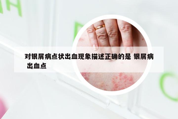 对银屑病点状出血现象描述正确的是 银屑病 出血点
