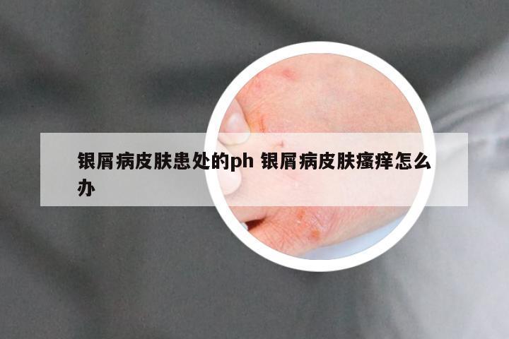 银屑病皮肤患处的ph 银屑病皮肤瘙痒怎么办