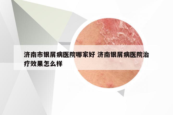 济南市银屑病医院哪家好 济南银屑病医院治疗效果怎么样