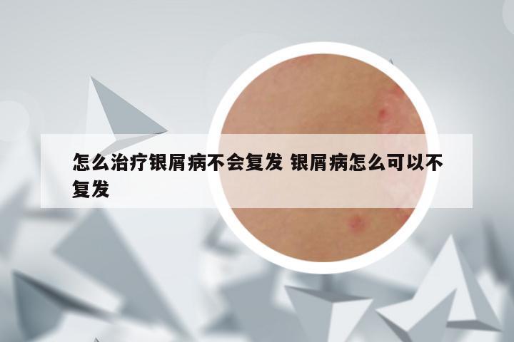 怎么治疗银屑病不会复发 银屑病怎么可以不复发