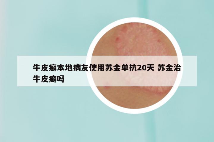 牛皮癣本地病友使用苏金单抗20天 苏金治牛皮癣吗