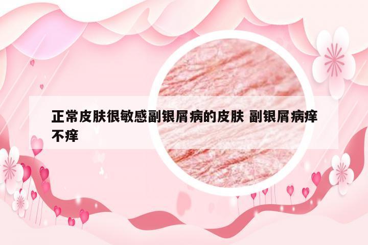 正常皮肤很敏感副银屑病的皮肤 副银屑病痒不痒