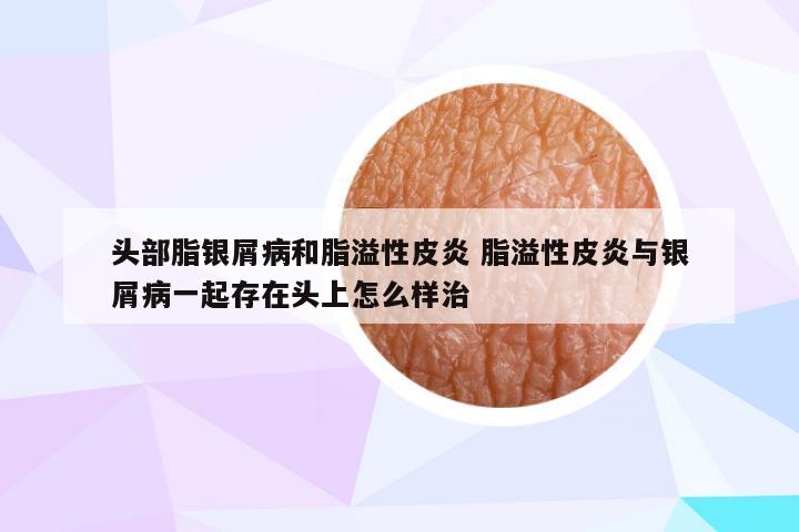 头部脂银屑病和脂溢性皮炎 脂溢性皮炎与银屑病一起存在头上怎么样治