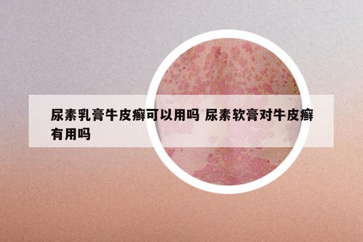 尿素乳膏牛皮癣可以用吗 尿素软膏对牛皮癣有用吗