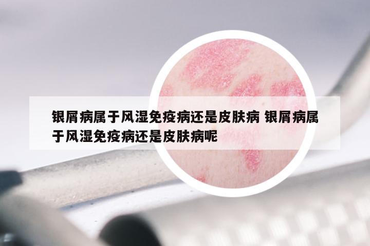 银屑病属于风湿免疫病还是皮肤病 银屑病属于风湿免疫病还是皮肤病呢