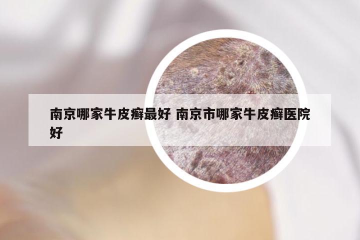 南京哪家牛皮癣最好 南京市哪家牛皮癣医院好