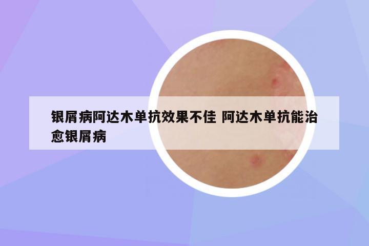 银屑病阿达木单抗效果不佳 阿达木单抗能治愈银屑病