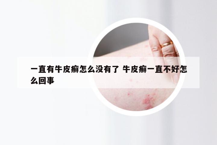 一直有牛皮癣怎么没有了 牛皮癣一直不好怎么回事