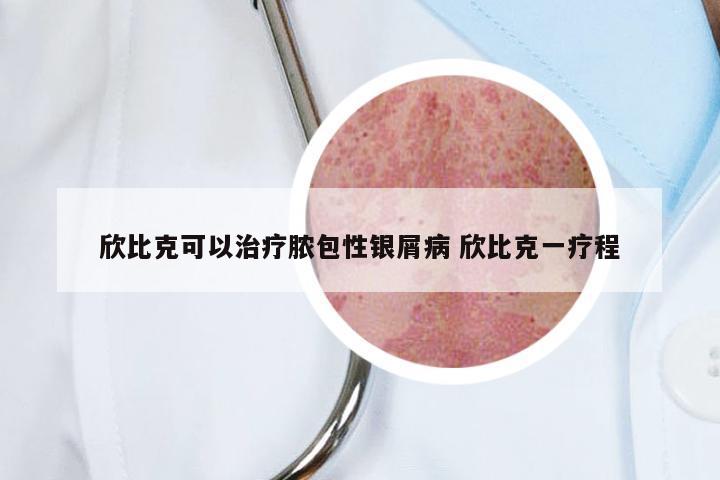 欣比克可以治疗脓包性银屑病 欣比克一疗程