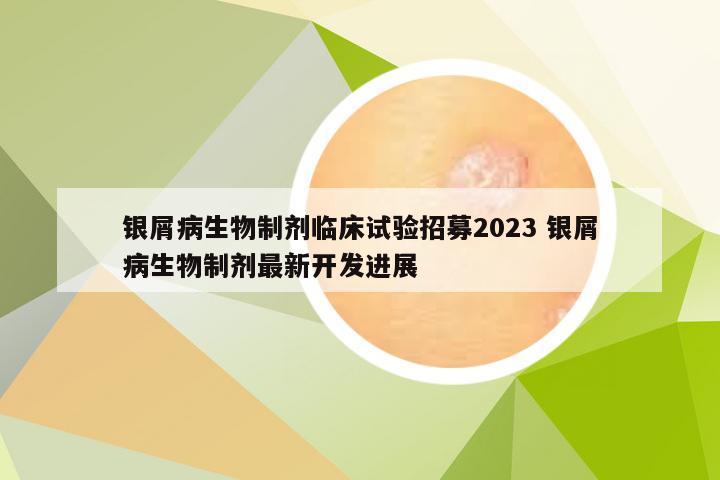 银屑病生物制剂临床试验招募2023 银屑病生物制剂最新开发进展