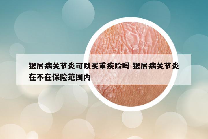 银屑病关节炎可以买重疾险吗 银屑病关节炎在不在保险范围内