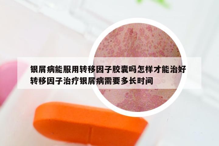 银屑病能服用转移因子胶囊吗怎样才能治好 转移因子治疗银屑病需要多长时间