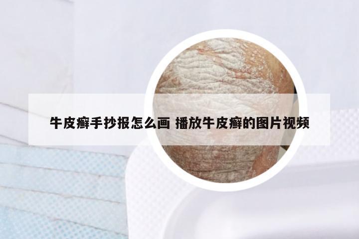 牛皮癣手抄报怎么画 播放牛皮癣的图片视频