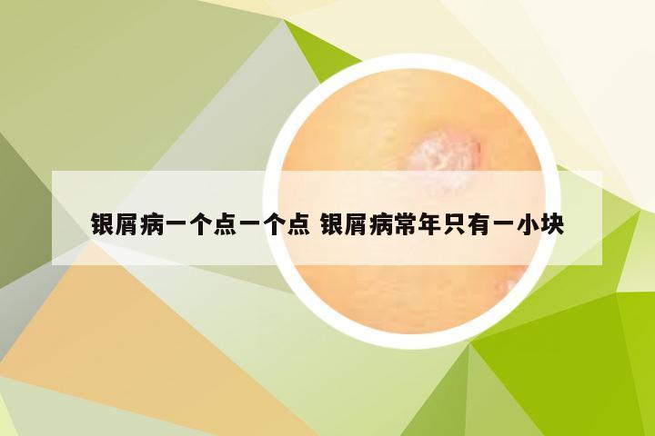 银屑病一个点一个点 银屑病常年只有一小块