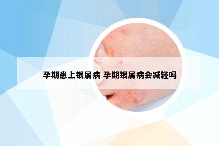 孕期患上银屑病 孕期银屑病会减轻吗