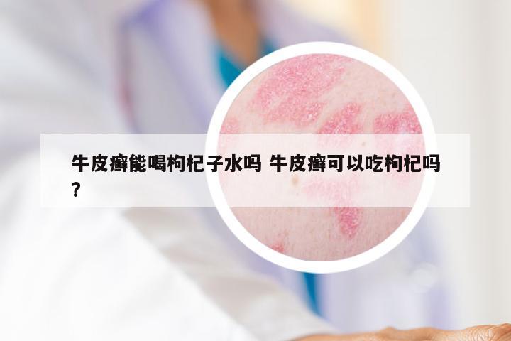 牛皮癣能喝枸杞子水吗 牛皮癣可以吃枸杞吗?