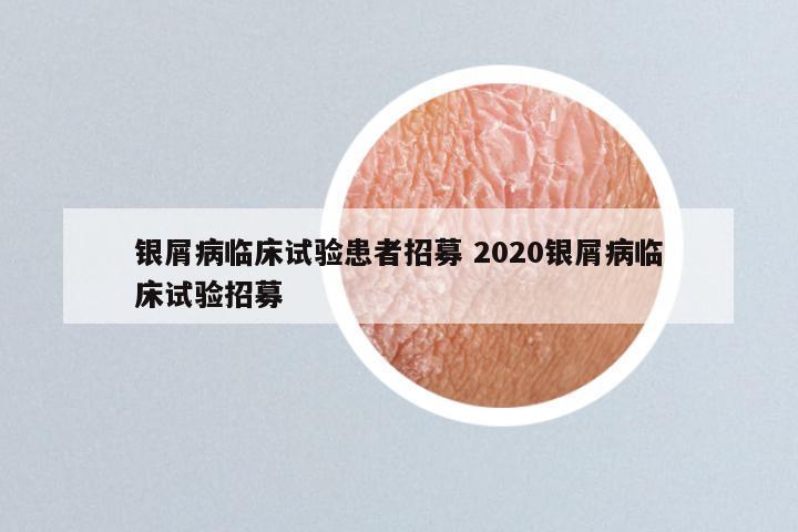 银屑病临床试验患者招募 2020银屑病临床试验招募