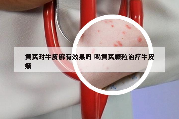 黄芪对牛皮癣有效果吗 喝黄芪颗粒治疗牛皮癣