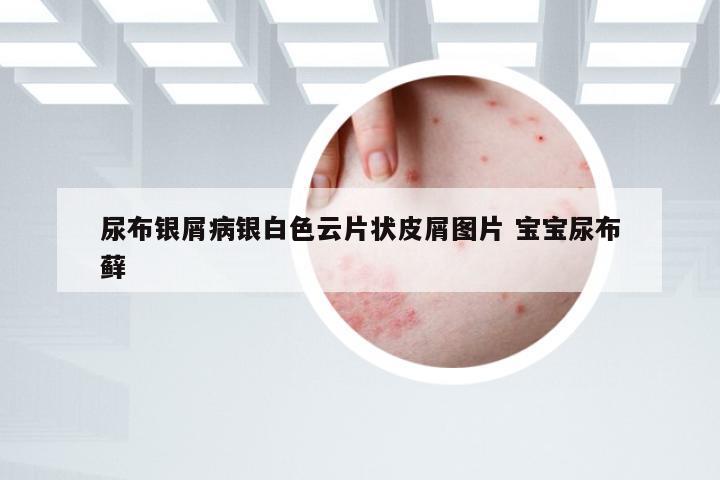尿布银屑病银白色云片状皮屑图片 宝宝尿布藓