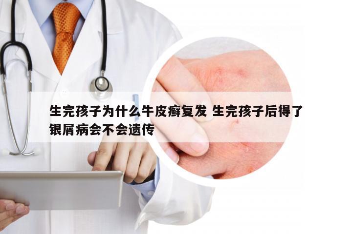 生完孩子为什么牛皮癣复发 生完孩子后得了银屑病会不会遗传