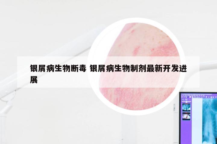 银屑病生物断毒 银屑病生物制剂最新开发进展