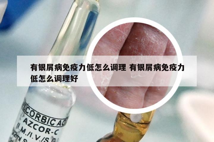 有银屑病免疫力低怎么调理 有银屑病免疫力低怎么调理好