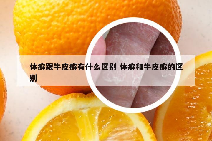 体癣跟牛皮癣有什么区别 体癣和牛皮癣的区别