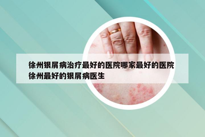 徐州银屑病治疗最好的医院哪家最好的医院 徐州最好的银屑病医生