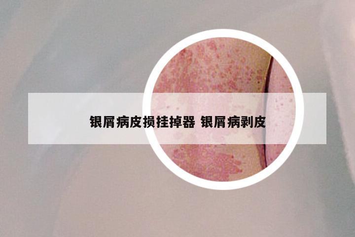 银屑病皮损挂掉器 银屑病剥皮