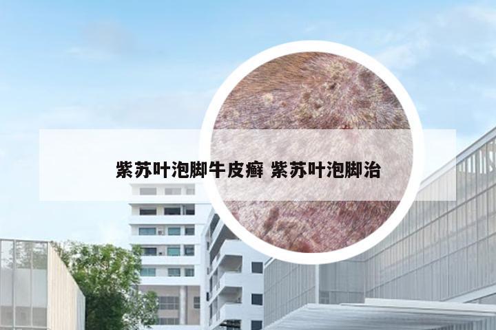 紫苏叶泡脚牛皮癣 紫苏叶泡脚治