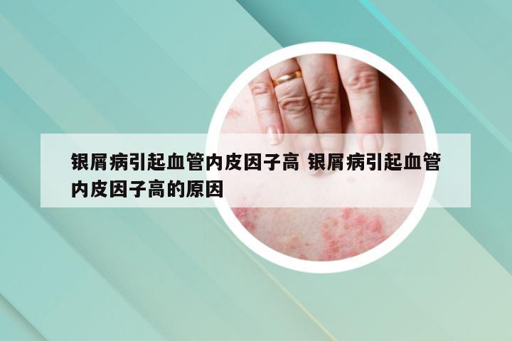 银屑病引起血管内皮因子高 银屑病引起血管内皮因子高的原因